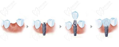 種植牙過程