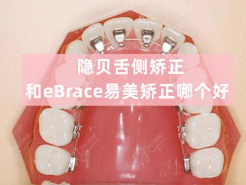 隱貝舌側(cè)矯正和eBrace易美矯正哪個(gè)好