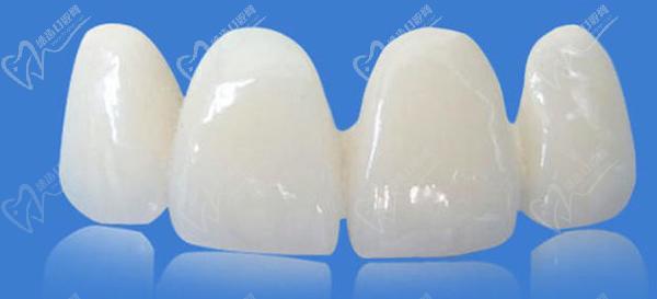 冰瓷牙和全瓷牙哪一個更好？看完冰瓷牙和全瓷牙的區(qū)別就明了