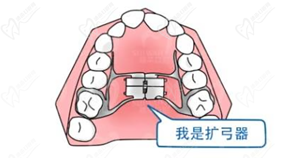 擴(kuò)弓器