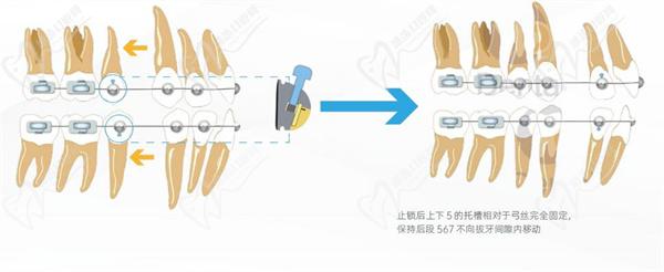 歐歐托槽矯正