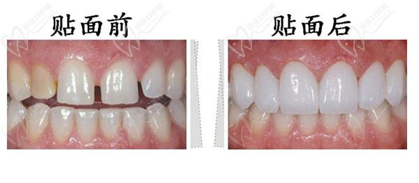 樹脂貼面前后對比