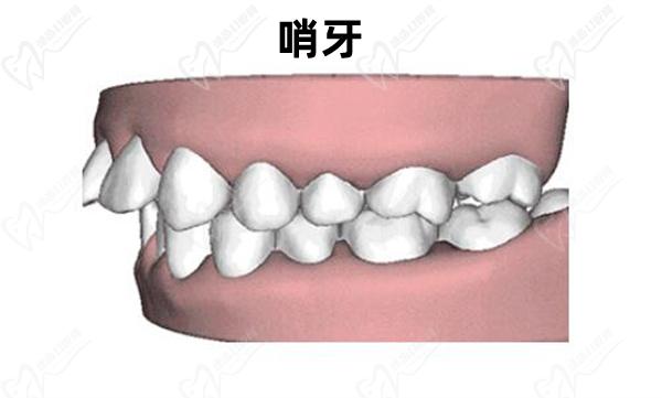 哨牙