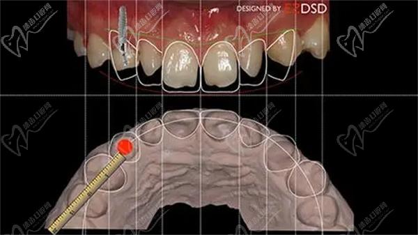 DSD牙齒美學(xué)修復(fù)技術(shù)