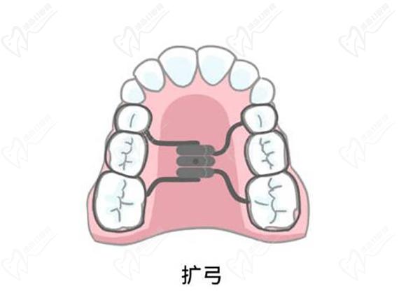 擴(kuò)牙弓一般擴(kuò)多少天