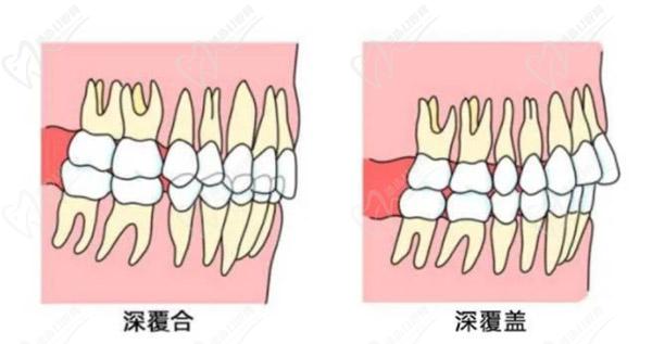 牙齒只深覆蓋正常嗎？深覆蓋有必要矯正嗎？看矯正后臉型變化