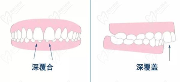 牙齒只深覆蓋正常嗎？深覆蓋有必要矯正嗎？看矯正后臉型變化