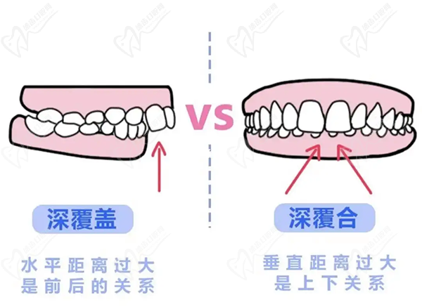 牙齒只深覆蓋正常嗎？深覆蓋有必要矯正嗎？看矯正后臉型變化