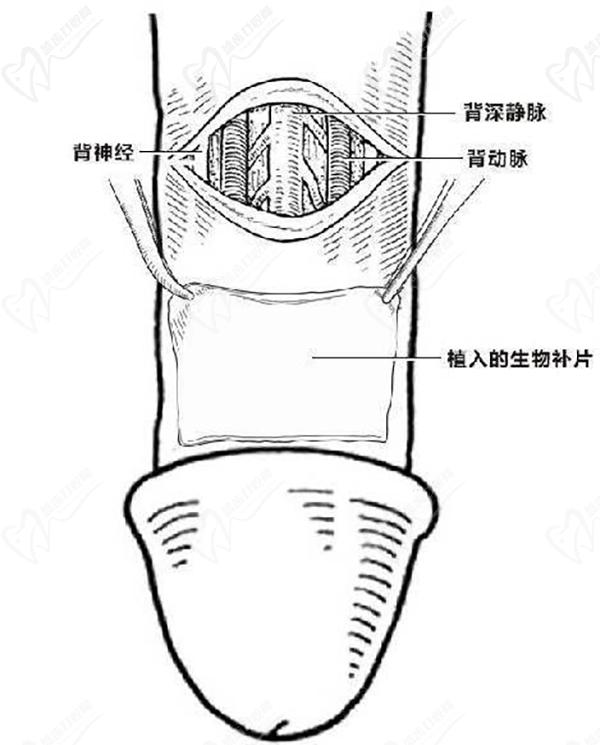 生物補(bǔ)片增粗手術(shù)<span style=