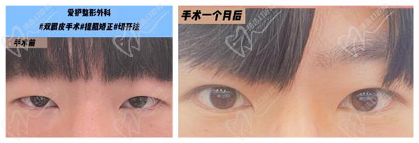 韓國愛護(hù)整形醫(yī)院眼修復(fù)
