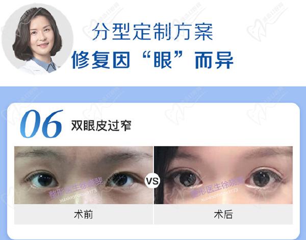 徐曉斐雙眼皮修復案 例