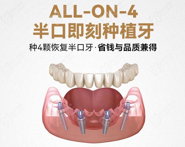 廣州柏德口腔半口種植牙價(jià)格