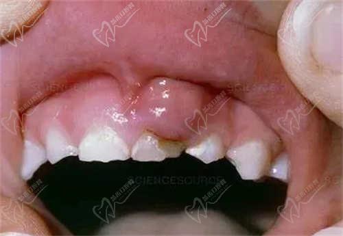 兒童慢性根尖周炎會(huì)影響恒牙嗎？