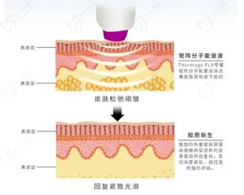 重慶軍科整形引進(jìn)超瑪吉FLX技術(shù)不錯