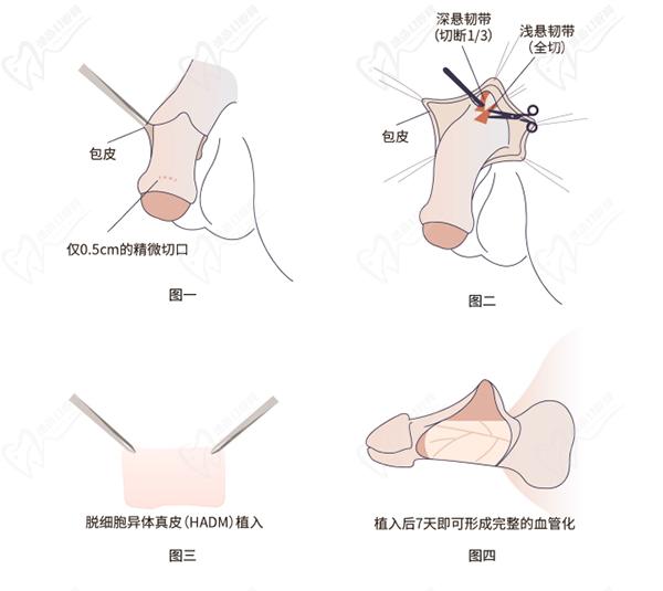 增長(zhǎng)手術(shù)可以增長(zhǎng)多少