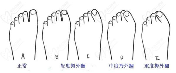 大腳骨手術(shù)的費用大概是多少錢啊