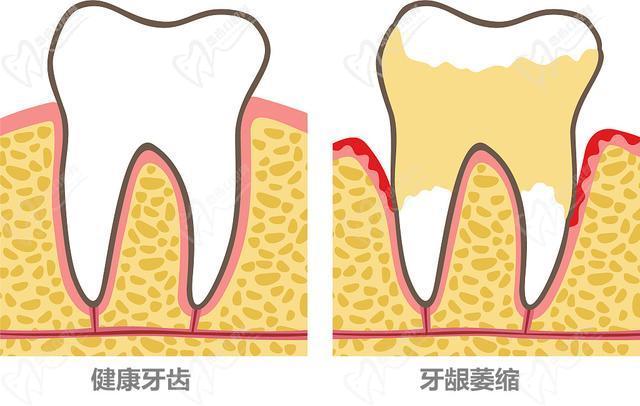 齦萎縮牙根露出