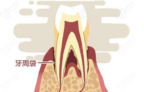 天津口腔醫(yī)院牙周炎刮治費用