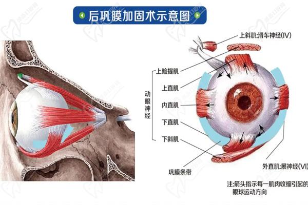 褚仁遠(yuǎn)后鞏膜加固手術(shù)采用的兜帶術(shù)