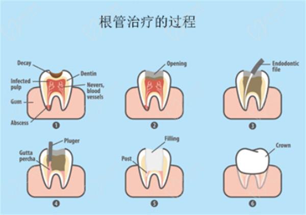 根管治療