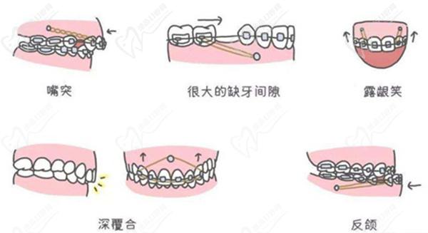 鄭州兒童牙齒矯正價(jià)格多少錢