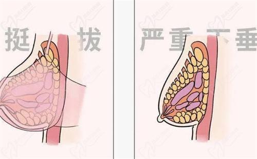 黃廣香和朱云做胸實例對比