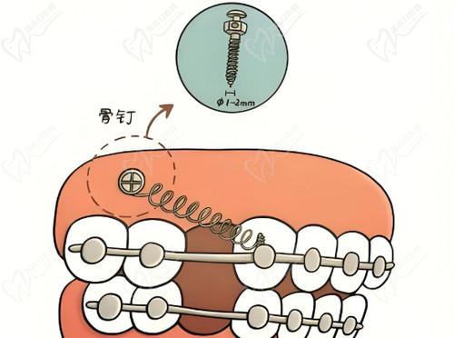 正畸打骨釘和不打骨釘的區(qū)別