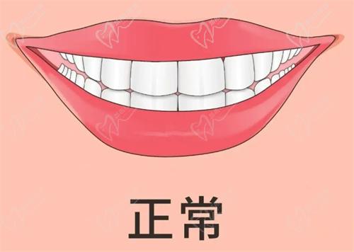 兒童早期矯正牙套的種類和價(jià)格