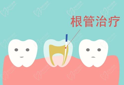 武漢中諾口腔根管治療怎么樣