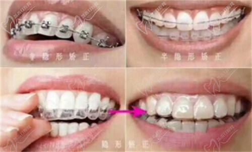 二、拜博口腔正畸價(jià)格的影響因素