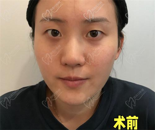 為什么選擇杜園園醫(yī)生做雙眼皮手術(shù)？