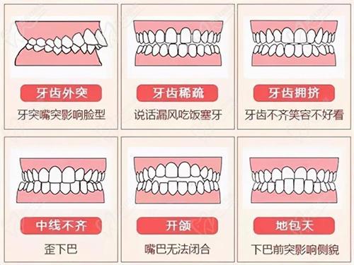 牙齒深覆合一度二度三度區(qū)別