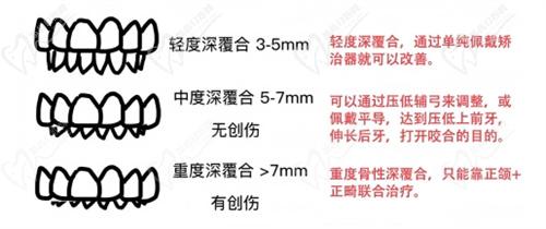 牙齒整齊但是深覆合需要矯正嗎
