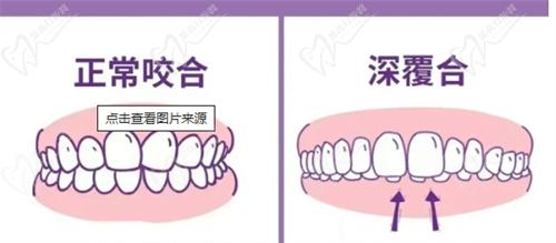 牙齒整齊但是深覆合需要矯正嗎