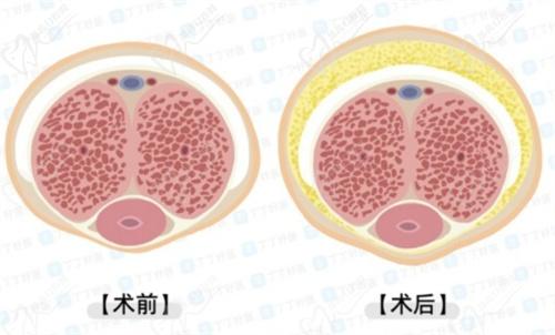 李世榮醫(yī)生做一次延長(zhǎng)手術(shù)多少錢