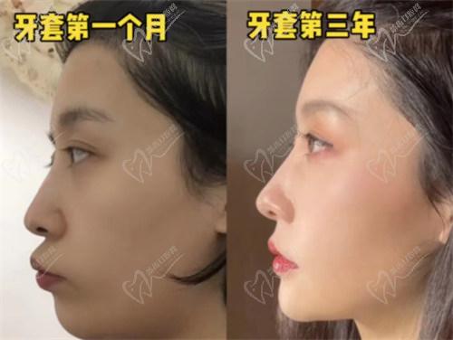 影響牙齒矯正價格的因素：