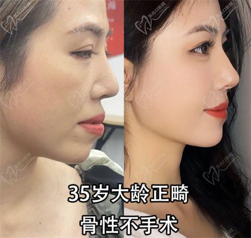 國內(nèi)牙齒矯正的流程：