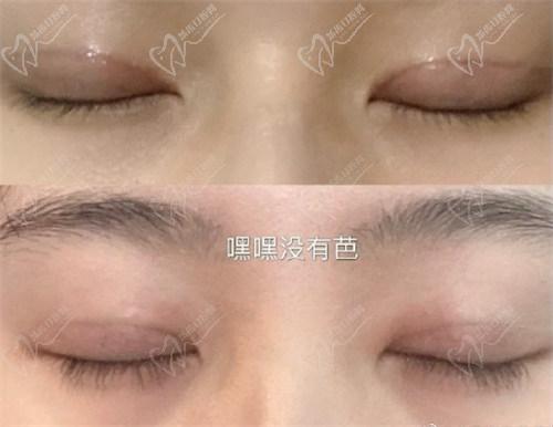 北京豐聯(lián)麗格醫(yī)療美容師麗麗修復(fù)雙眼皮怎么樣？
