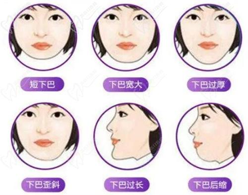一、下巴截骨前移手術(shù)多少錢？下巴截骨前移手術(shù)的費用