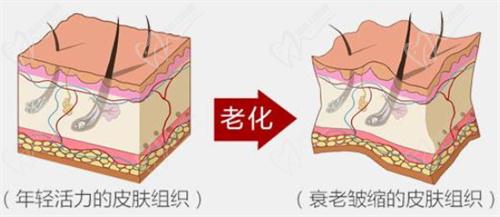 一、面部提拉小切口手術(shù)簡介