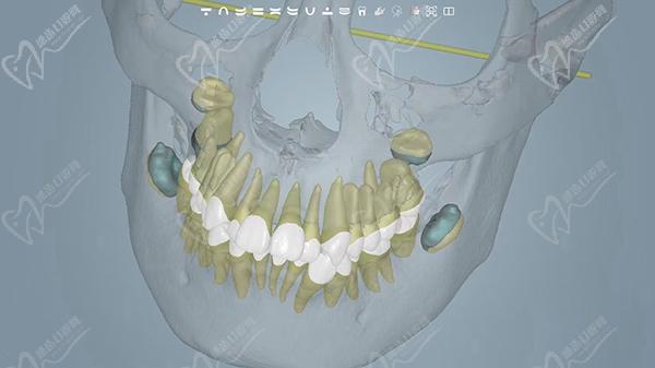 牙科矯正牙齒收費(fèi)價(jià)目表