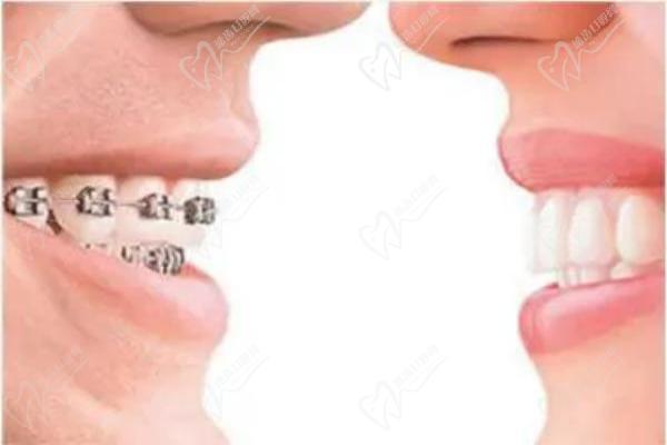 怎么區(qū)分正畸mbt與roth托槽？對比兩者區(qū)別來看哪個好附價格