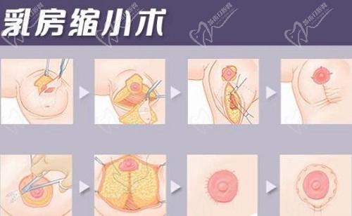 重慶劉正茂醫(yī)生縮胸怎么樣？
