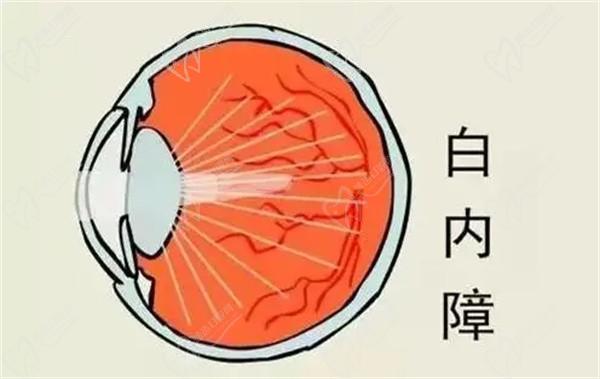 上海醫(yī)大眼科白內障手術8千-3萬起，不同品牌晶體價格有些許差異