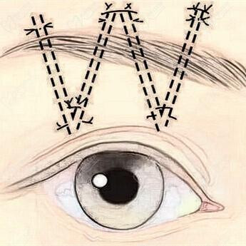 杜圓圓提眉多少錢-1.3W微創(chuàng)提眉愈后快可接修復(fù)看真人案例