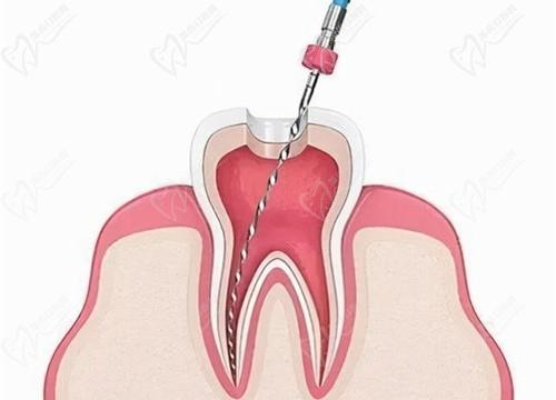 武漢中諾口腔根管治療價格給你，微創(chuàng)根管治療治牙髓炎根尖周炎等問題