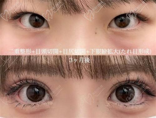 北京豐聯(lián)麗格醫(yī)療美容師麗麗修復(fù)雙眼皮怎么樣？肉條眼修復(fù)解決假寬深疤痕更隱形