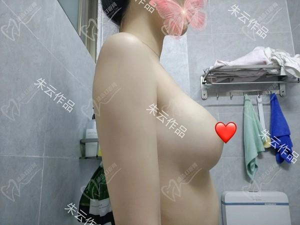 廣州朱云做胸怎么樣？是華南僅此一位做筋膜層隆胸的院長(zhǎng)名咖技術(shù)精妙口碑高