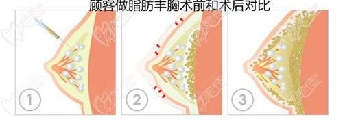?廣州朱云醫(yī)生擅長(zhǎng)筋膜層微痛隆胸/不良胸修復(fù)/自體脂肪復(fù)合隆胸，技術(shù)真的特別膩害！