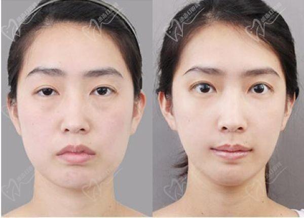 上海張詩若修復雙眼皮內眼角怎么樣？技術優(yōu)勢+真實實例+收費一覽